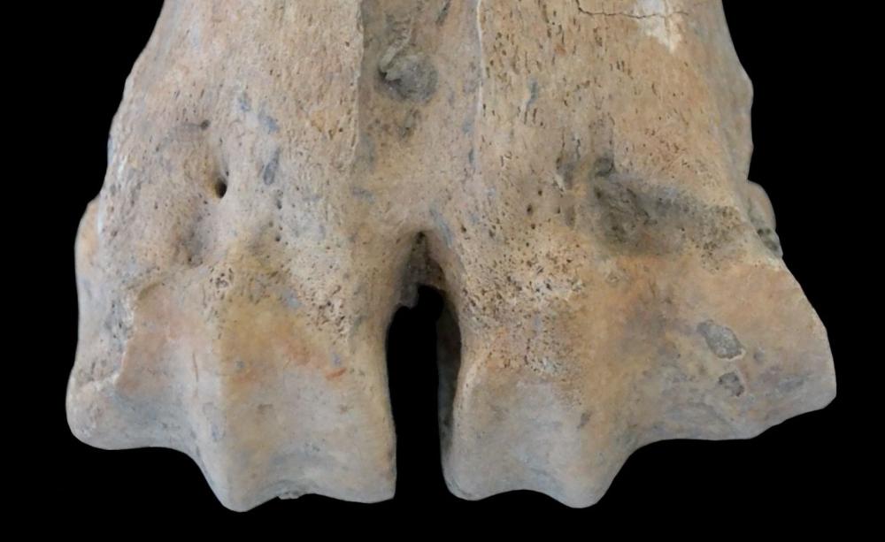 Medial enlargement of the articular surface of a metatarsal