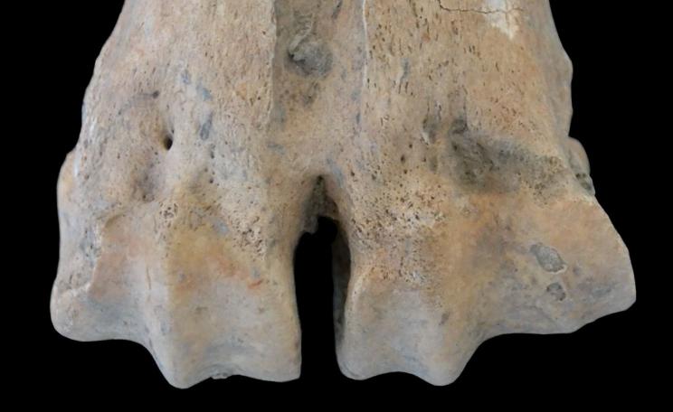 Medial enlargement of the articular surface of a metatarsal